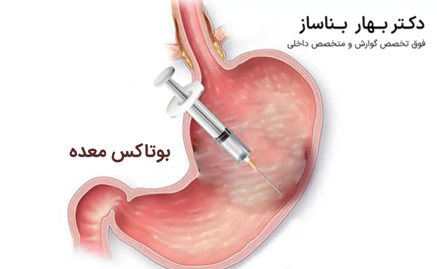 بعد از عمل اسلیو چقدر باید راه رفت+بوتاکس معده چگونه است+بوتاکس معده برای چه وزنی مناسب است+کدام عمل لاغری بدون بازگشت است
