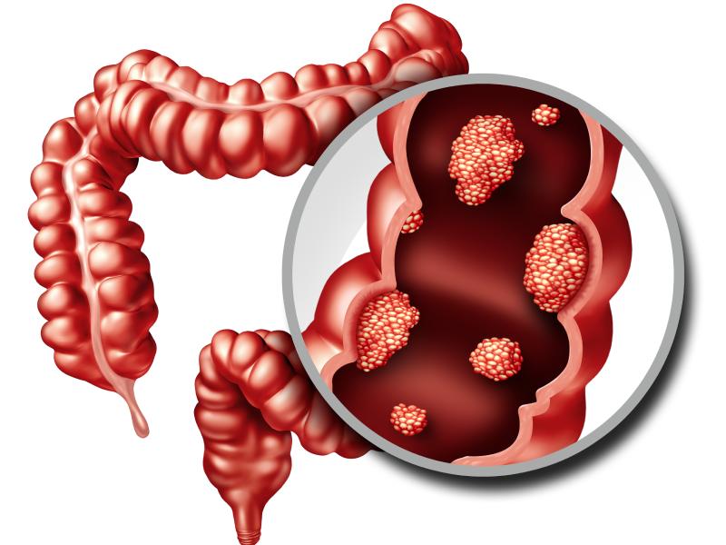 علت و علائم سرطان روده بزرگ