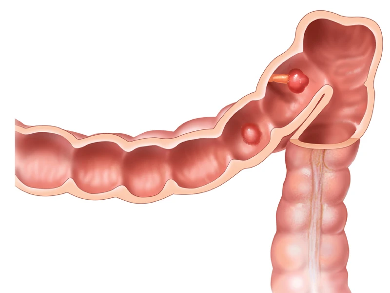 علت و علائم پولیپ روده